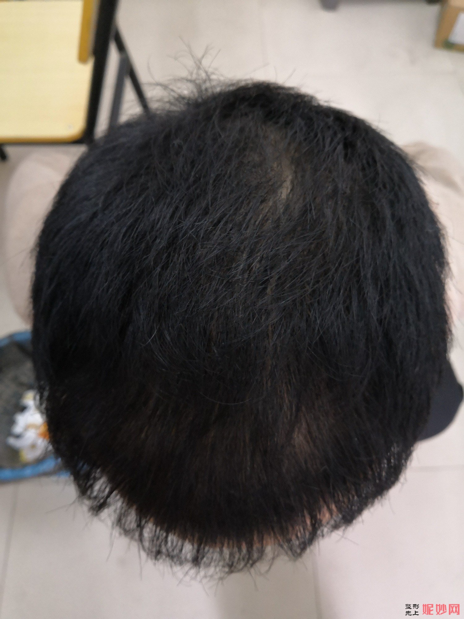 郑州和沐医疗整形口碑怎么样，附发际线种植案例_价格表