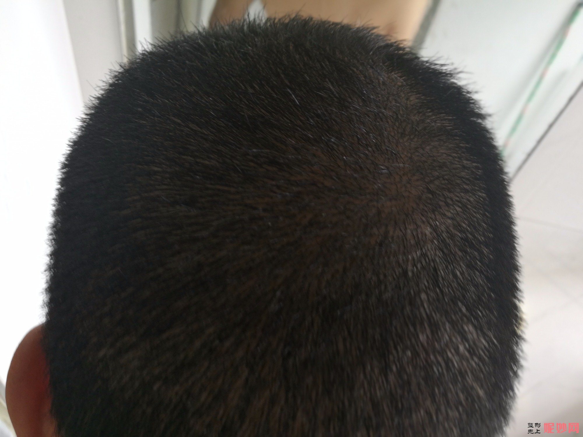 郑州和沐医疗整形口碑怎么样，附发际线种植案例_价格表