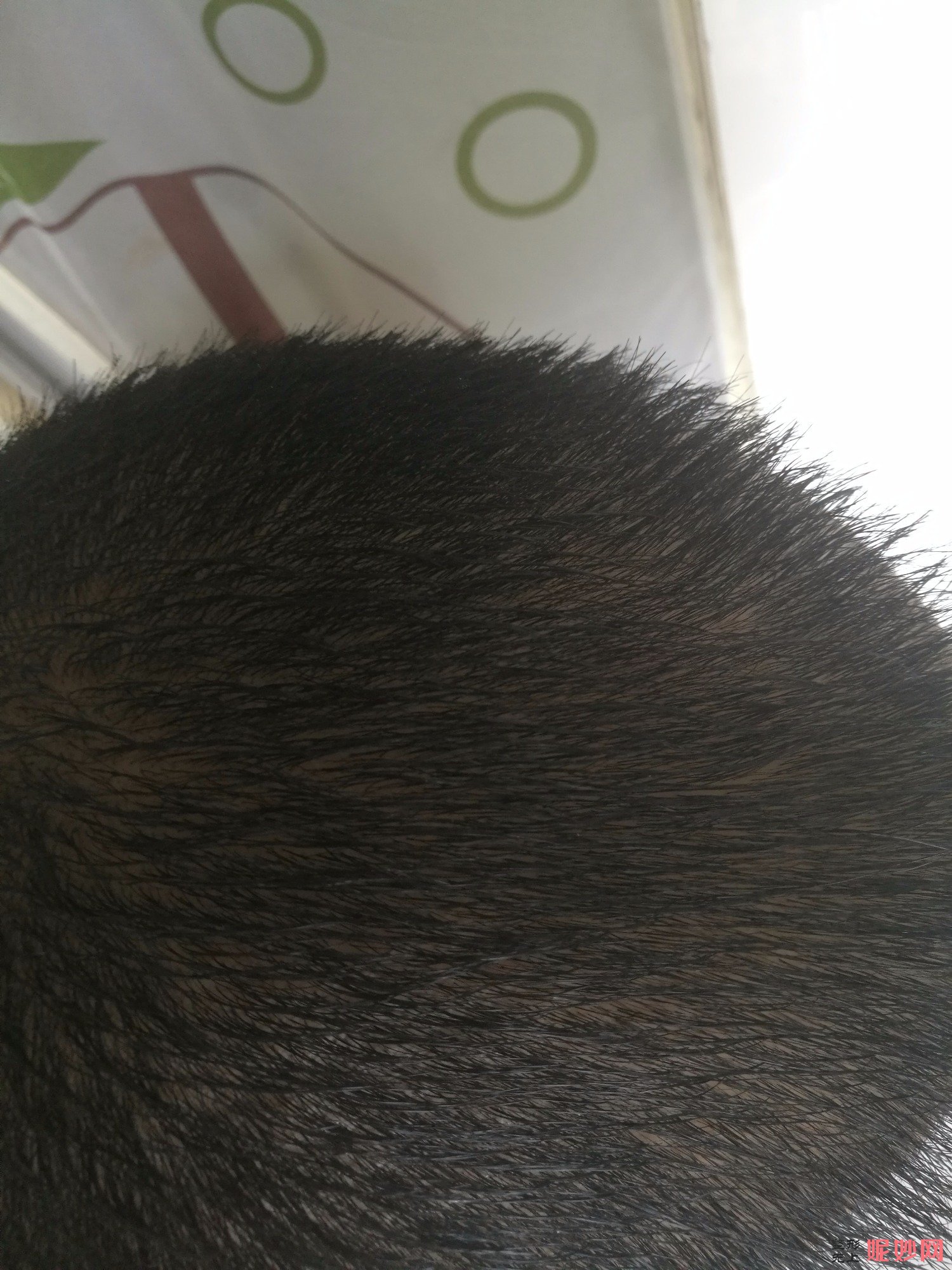 郑州和沐医疗整形口碑怎么样，附发际线种植案例_价格表