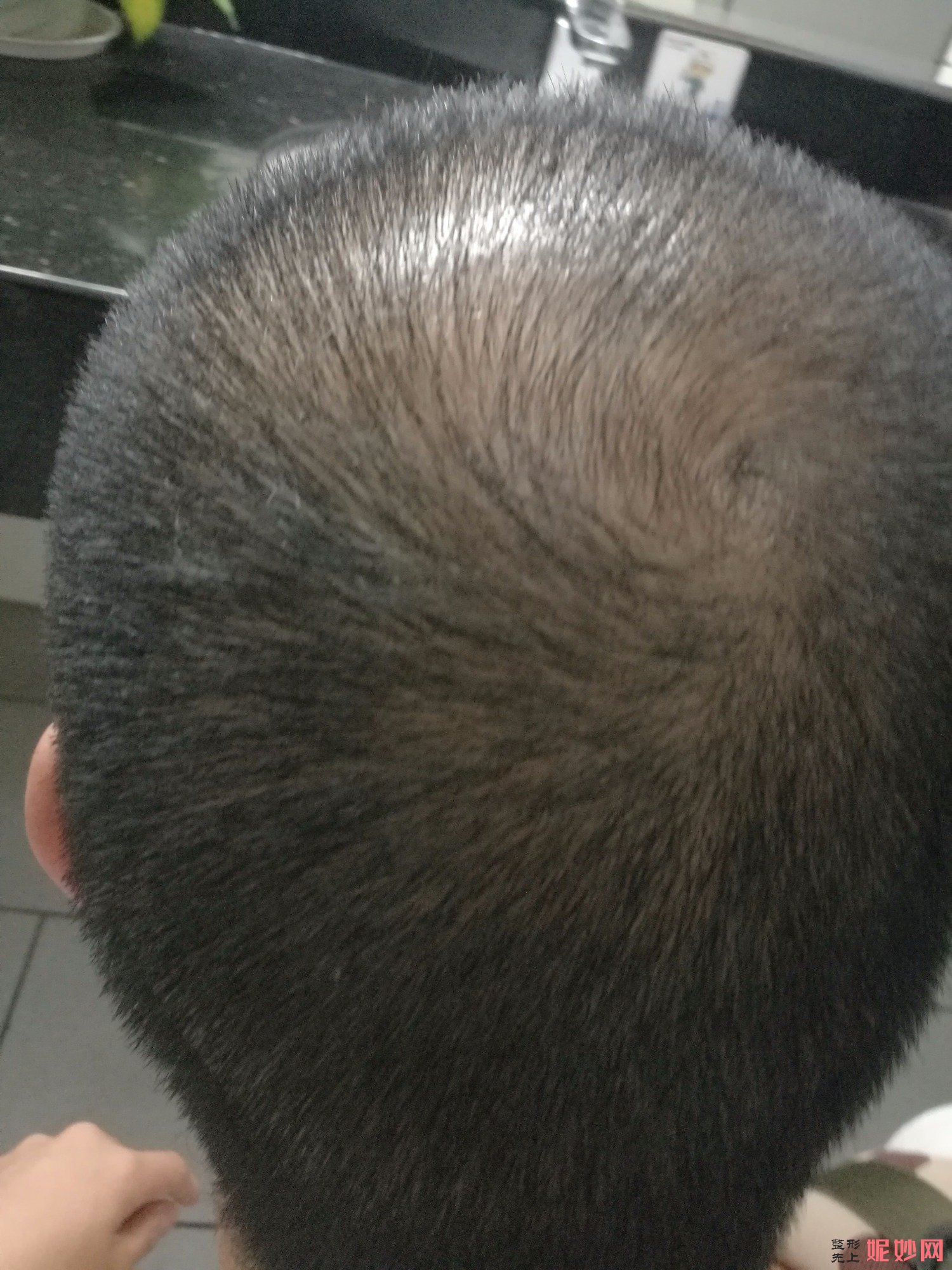 郑州和沐医疗整形口碑怎么样，附发际线种植案例_价格表