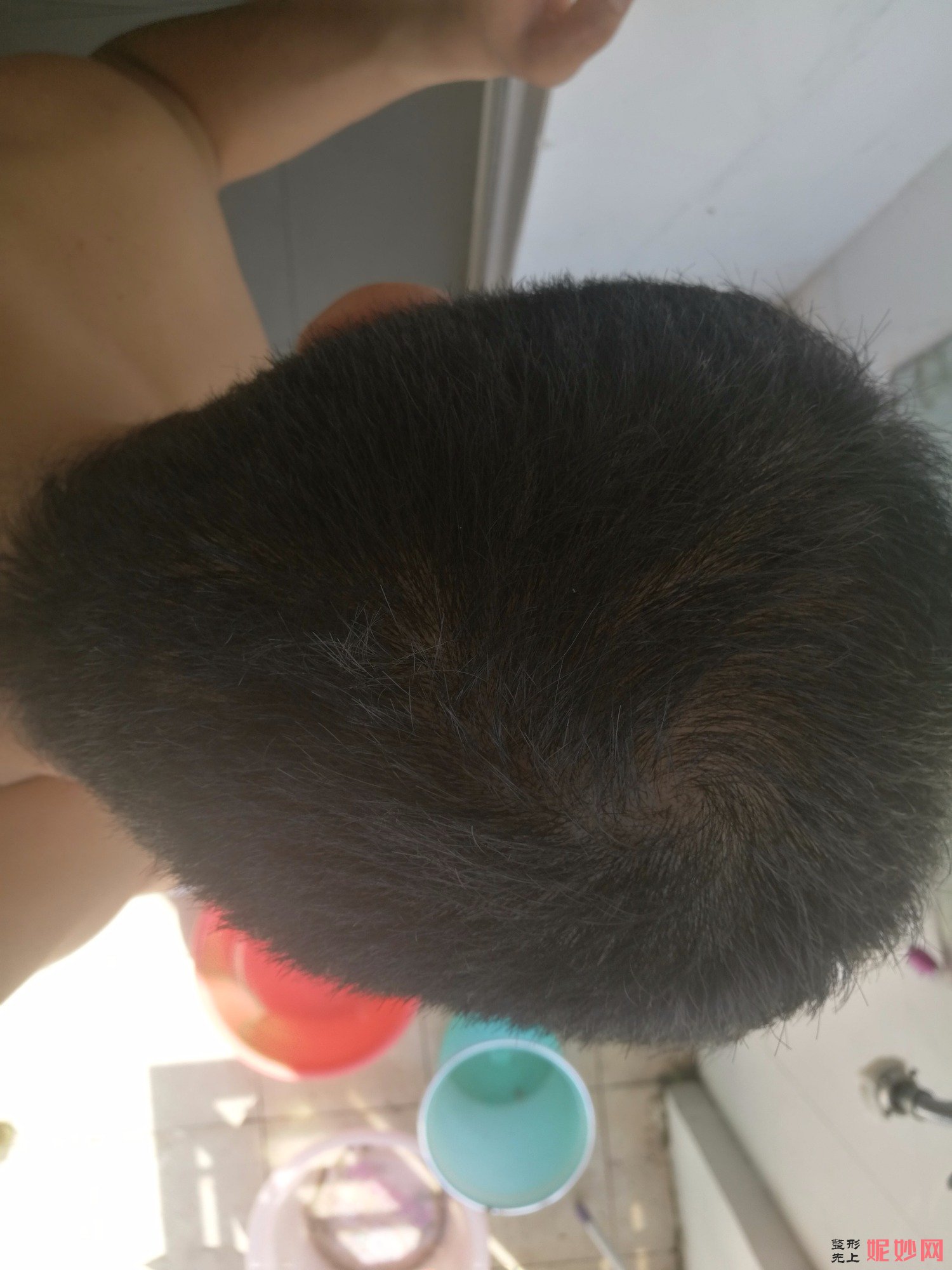 郑州和沐医疗整形口碑怎么样，附发际线种植案例_价格表