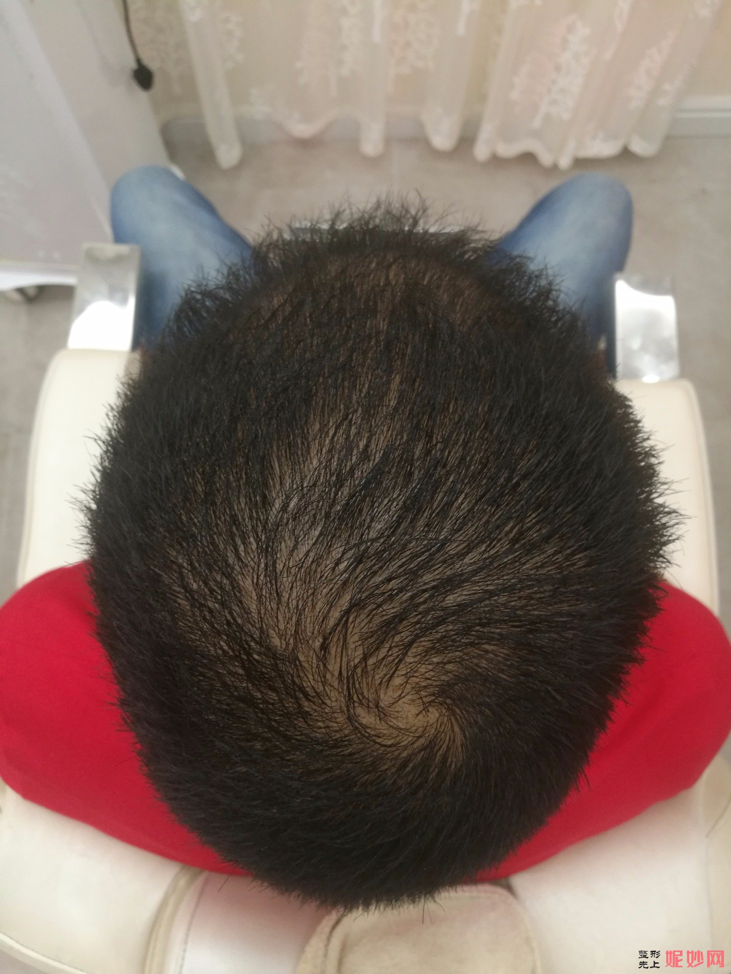 郑州和沐医疗整形口碑怎么样，附发际线种植案例_价格表