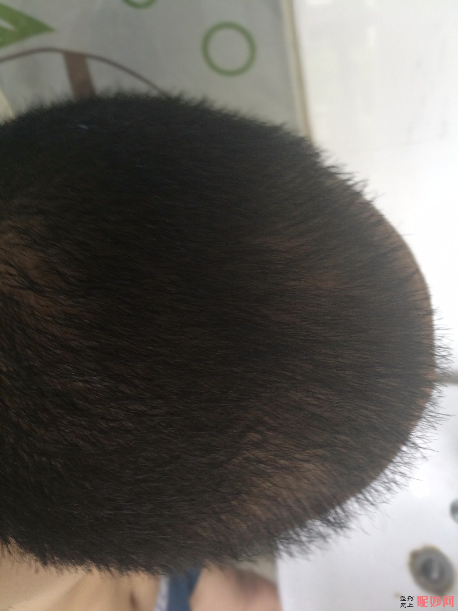 郑州和沐医疗整形口碑怎么样，附发际线种植案例_价格表
