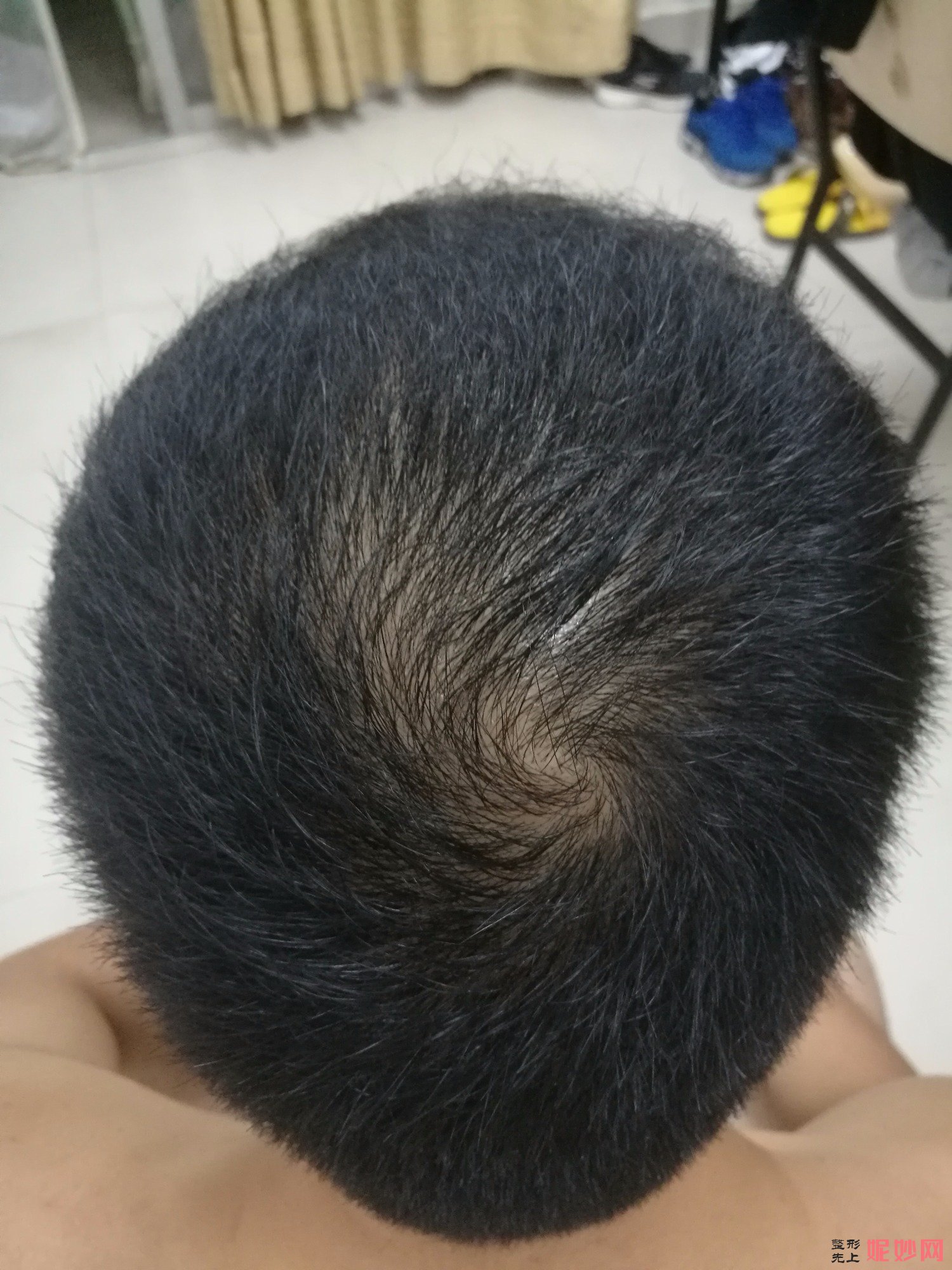 郑州和沐医疗整形口碑怎么样，附发际线种植案例_价格表