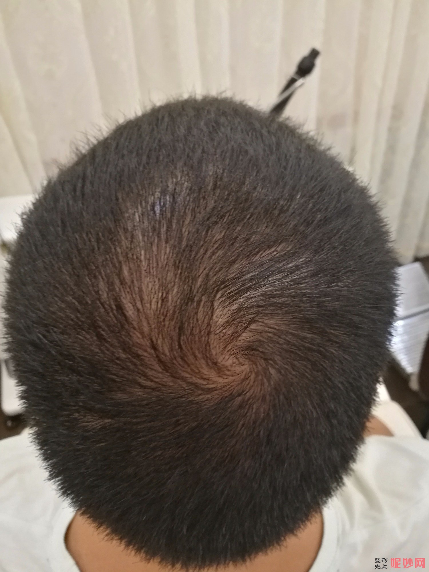郑州和沐医疗整形口碑怎么样，附发际线种植案例_价格表