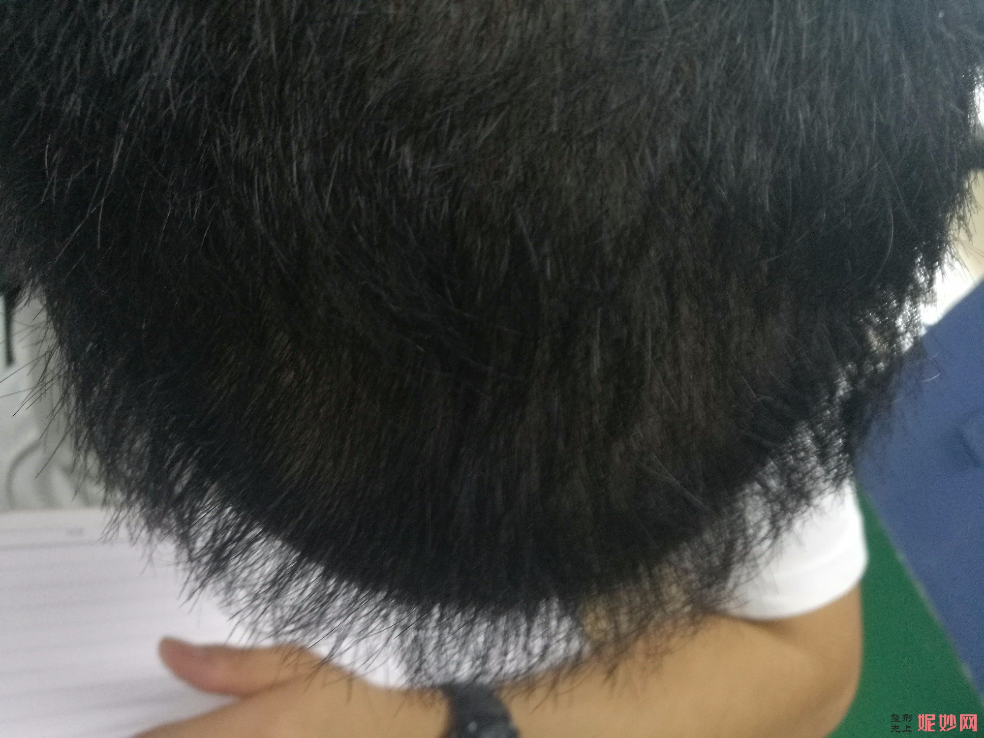 郑州和沐医疗整形口碑怎么样，附发际线种植案例_价格表