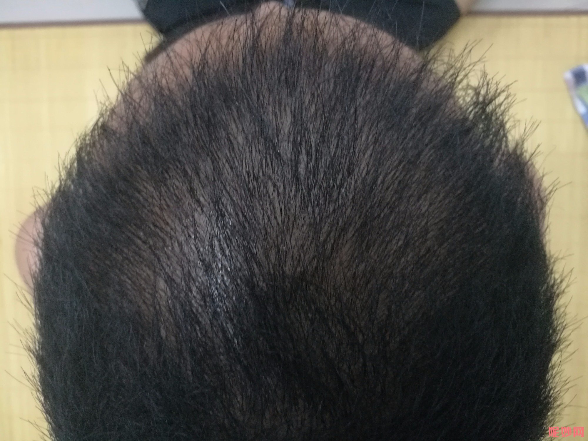 郑州和沐医疗整形口碑怎么样，附发际线种植案例_价格表