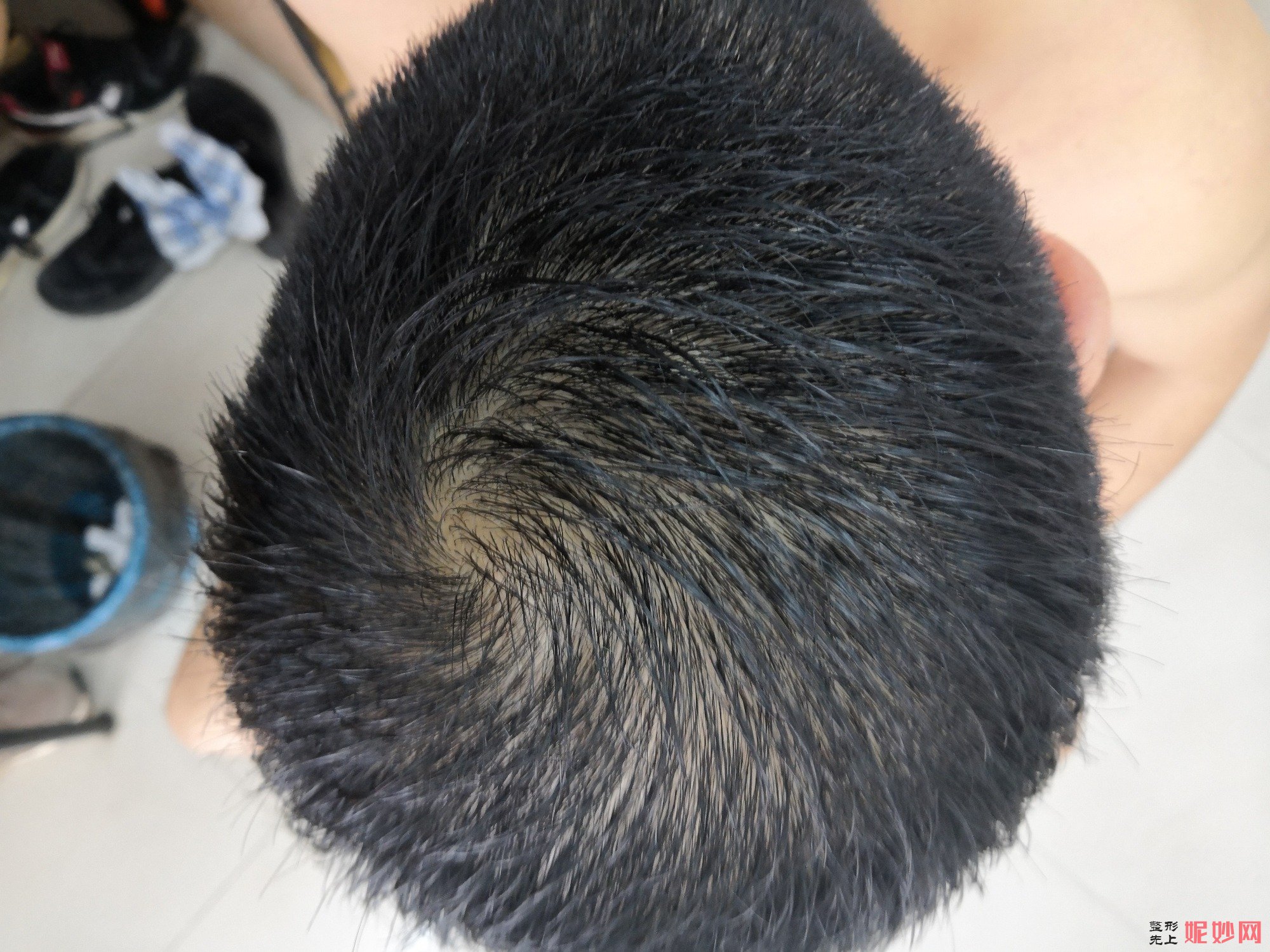 郑州和沐医疗整形口碑怎么样，附发际线种植案例_价格表
