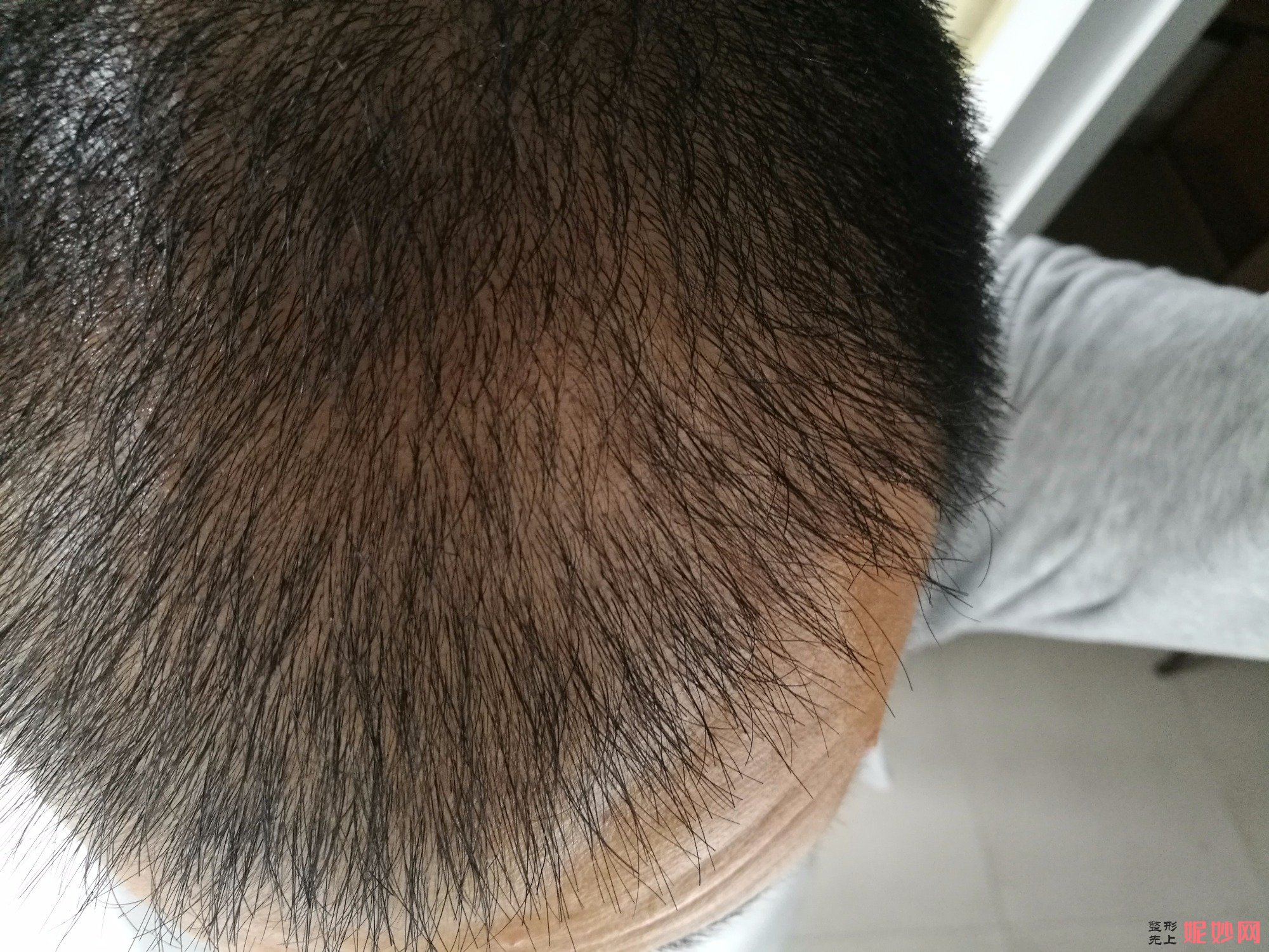 郑州和沐医疗整形口碑怎么样，附发际线种植案例_价格表