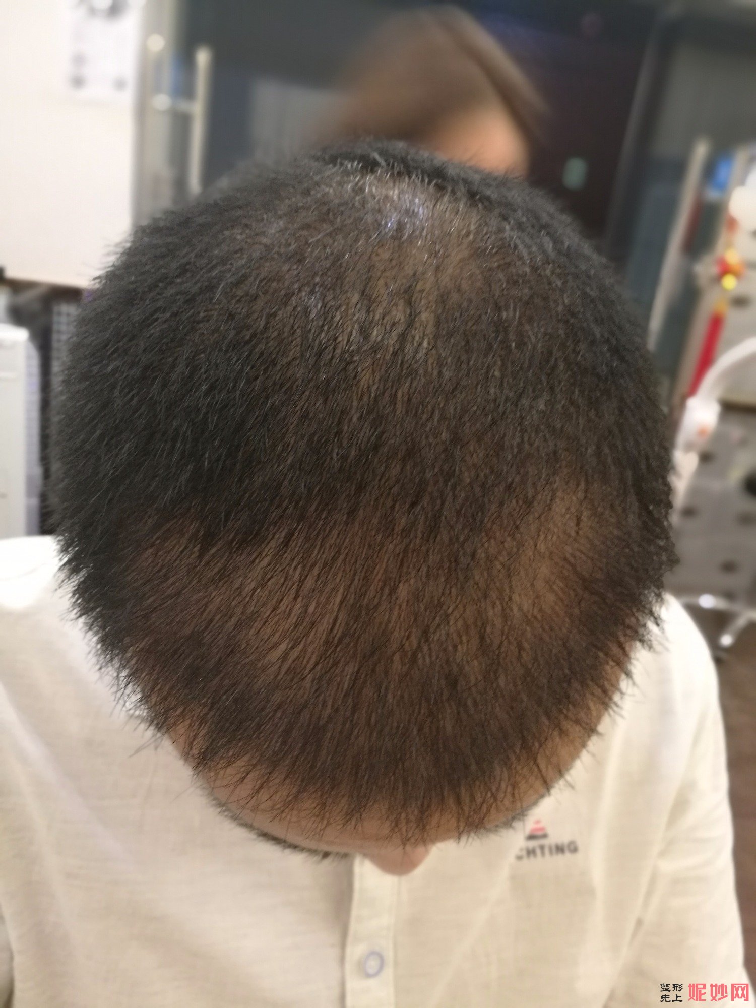 郑州和沐医疗整形口碑怎么样，附发际线种植案例_价格表