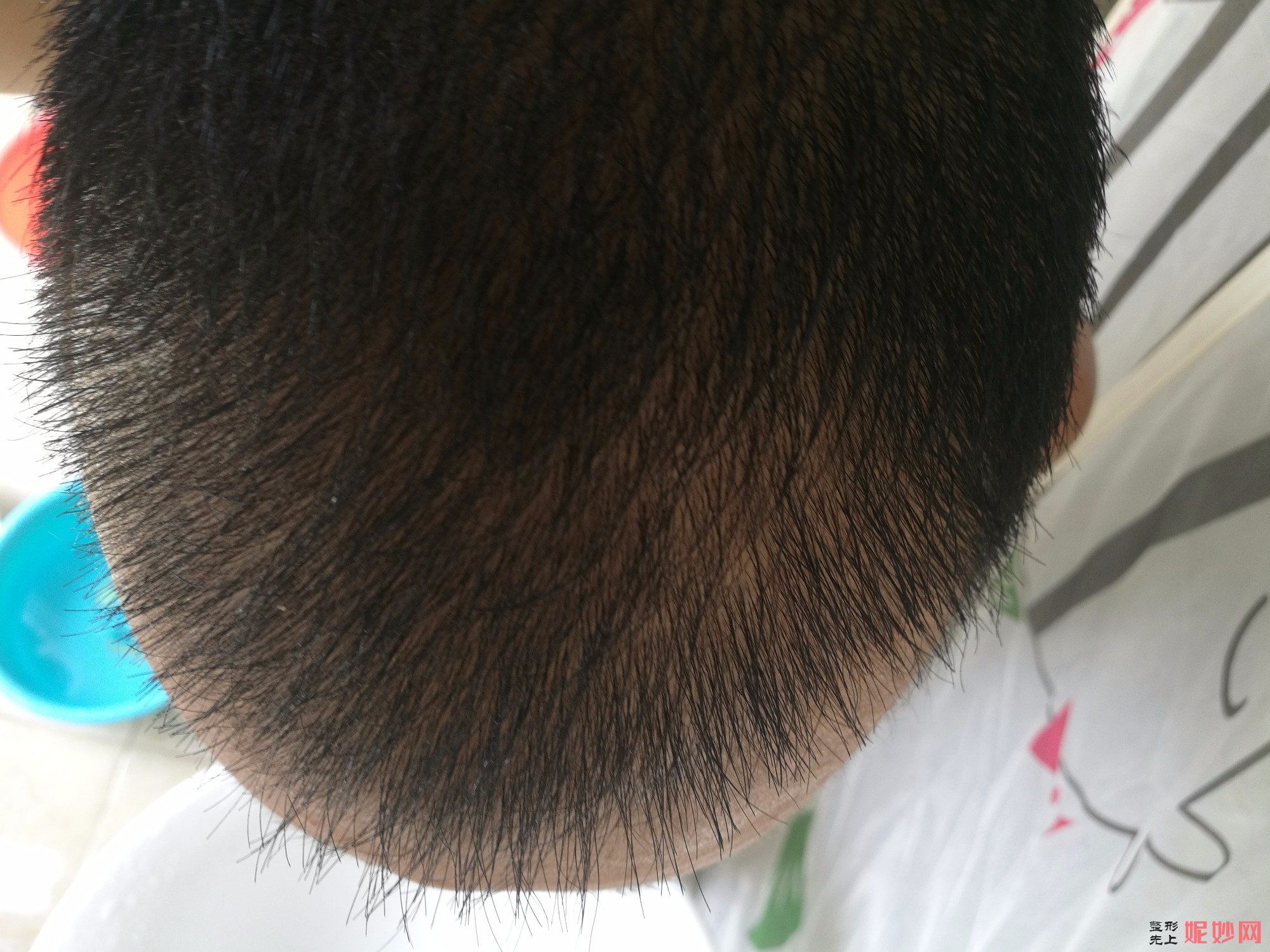 郑州和沐医疗整形口碑怎么样，附发际线种植案例_价格表