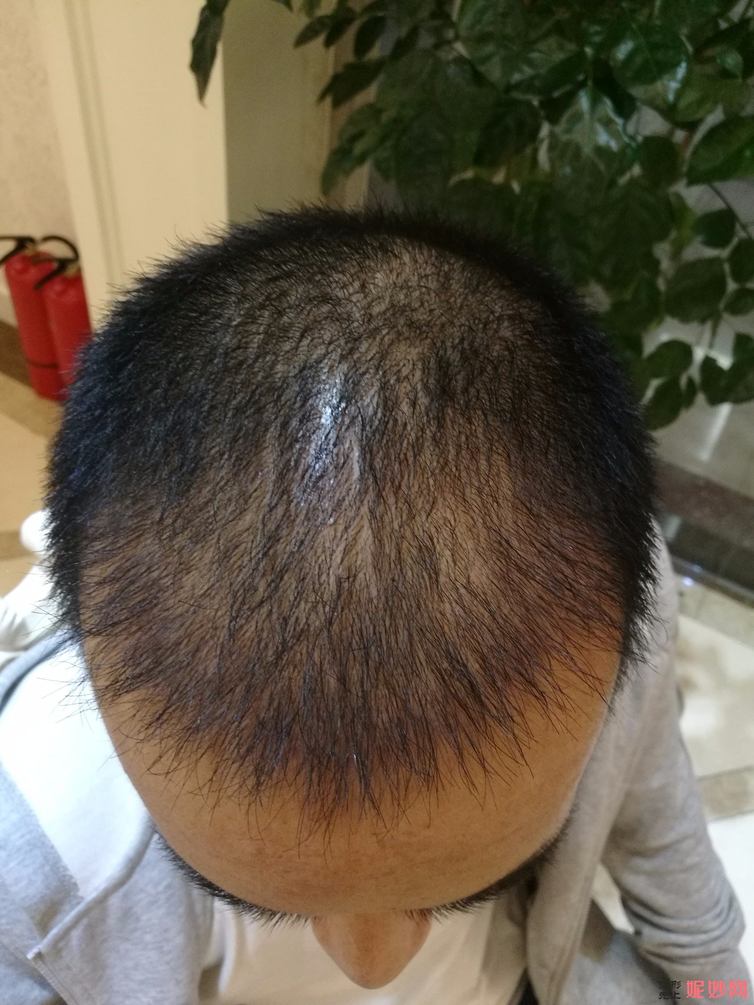 郑州和沐医疗整形口碑怎么样，附发际线种植案例_价格表