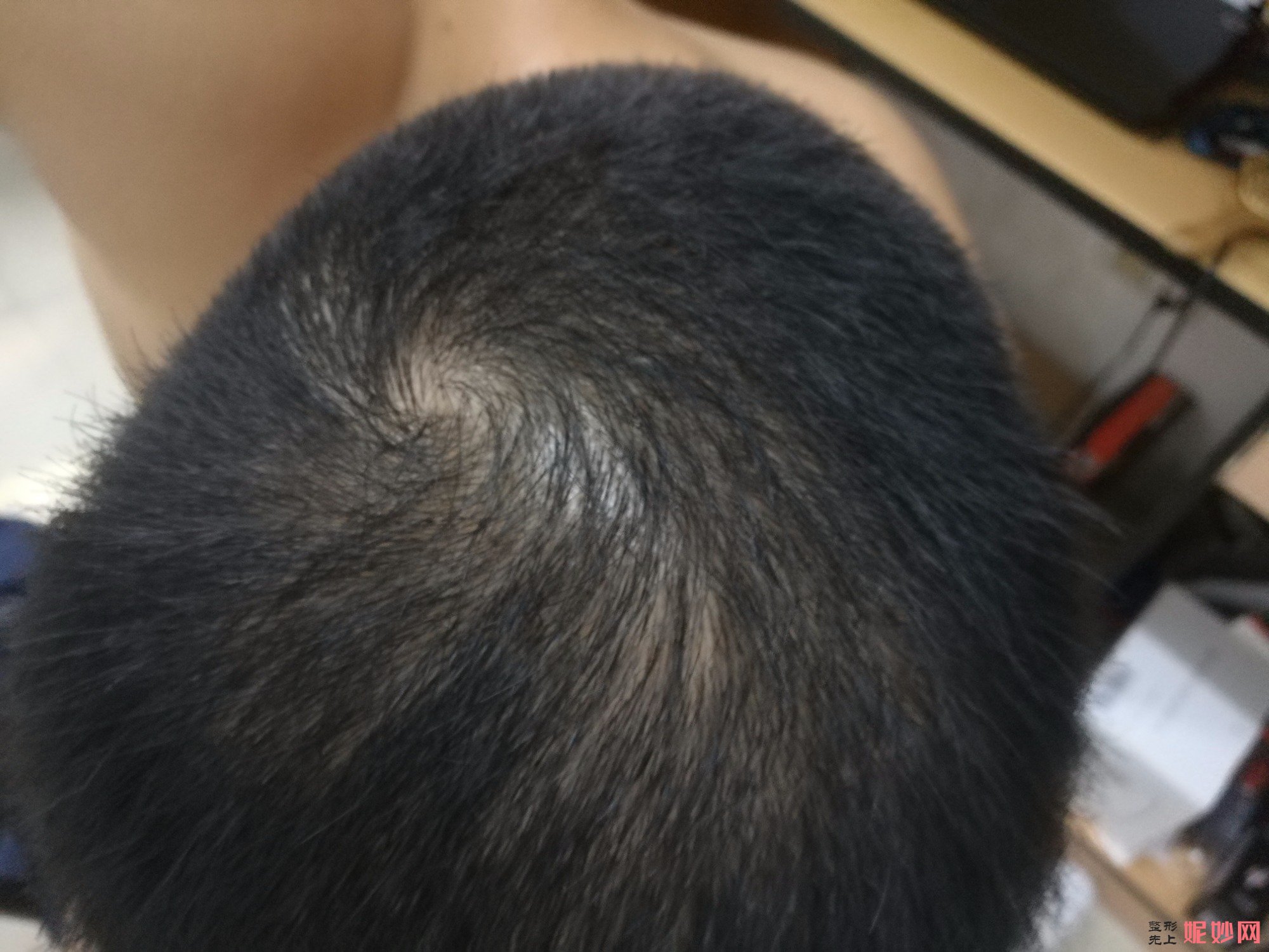 郑州和沐医疗整形口碑怎么样，附发际线种植案例_价格表