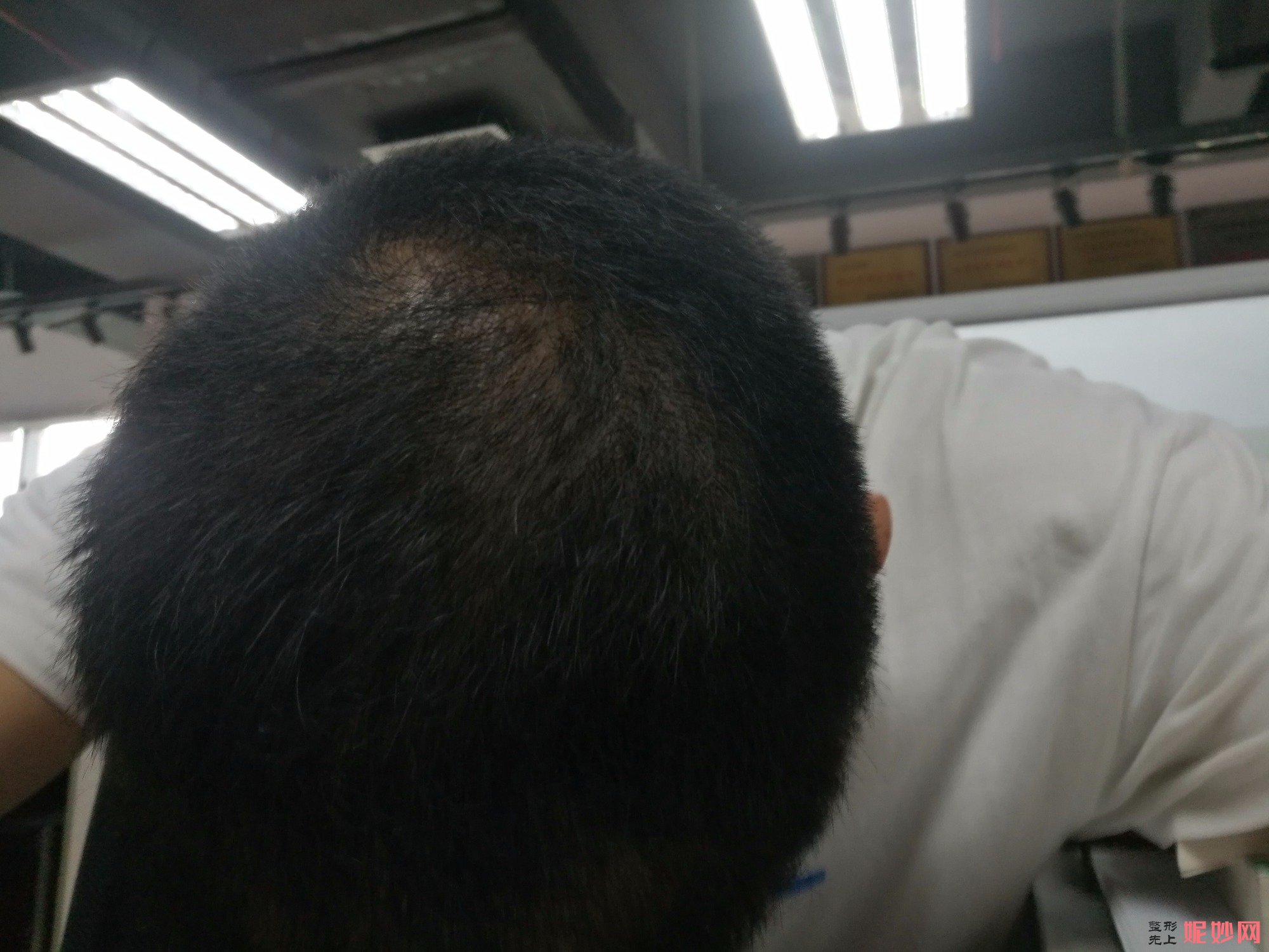 郑州和沐医疗整形口碑怎么样，附发际线种植案例_价格表