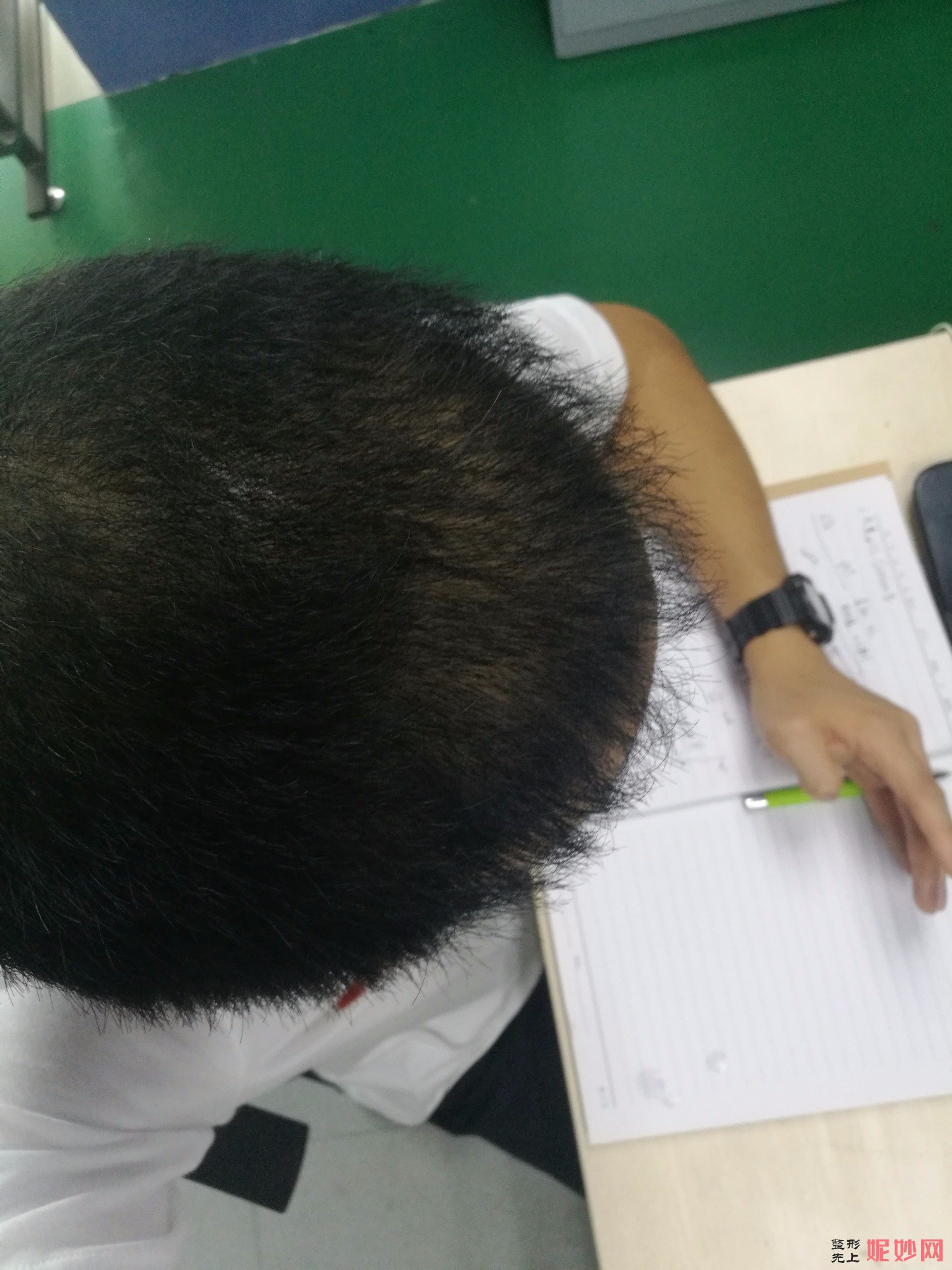 郑州和沐医疗整形口碑怎么样，附发际线种植案例_价格表