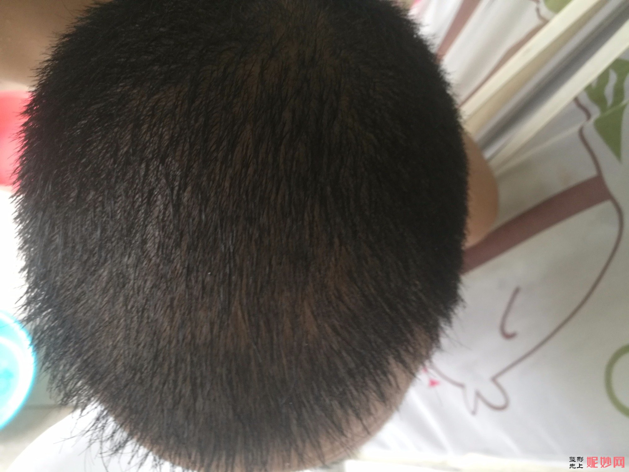 郑州和沐医疗整形口碑怎么样，附发际线种植案例_价格表