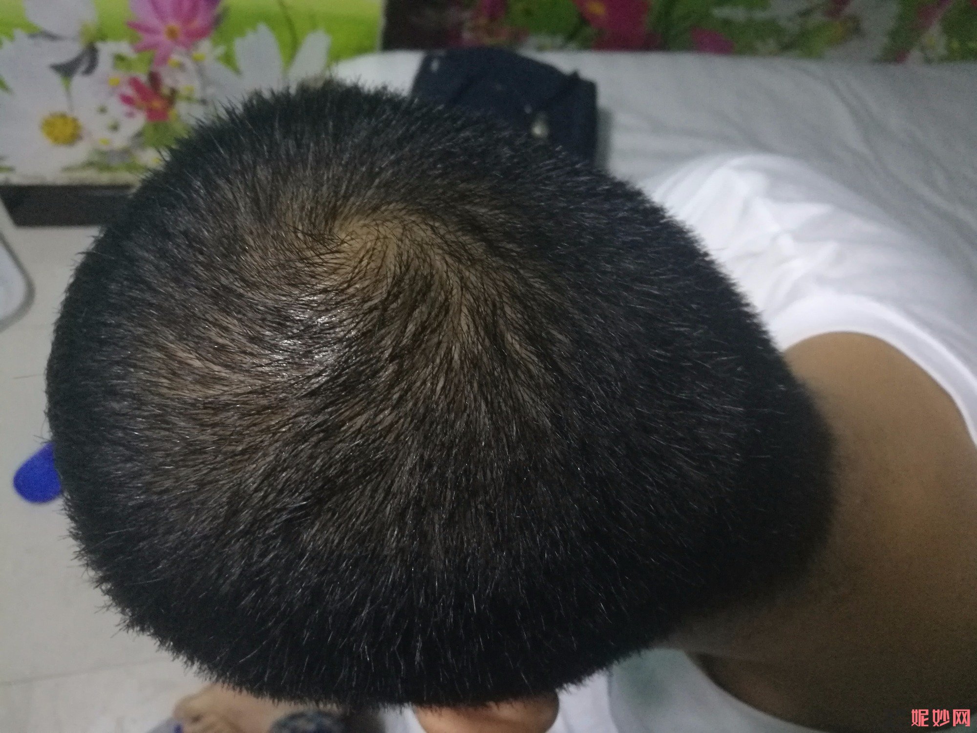 郑州和沐医疗整形口碑怎么样，附发际线种植案例_价格表
