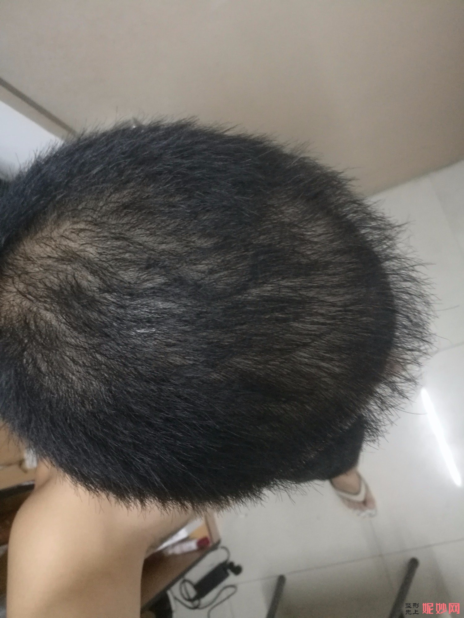 郑州和沐医疗整形口碑怎么样，附发际线种植案例_价格表