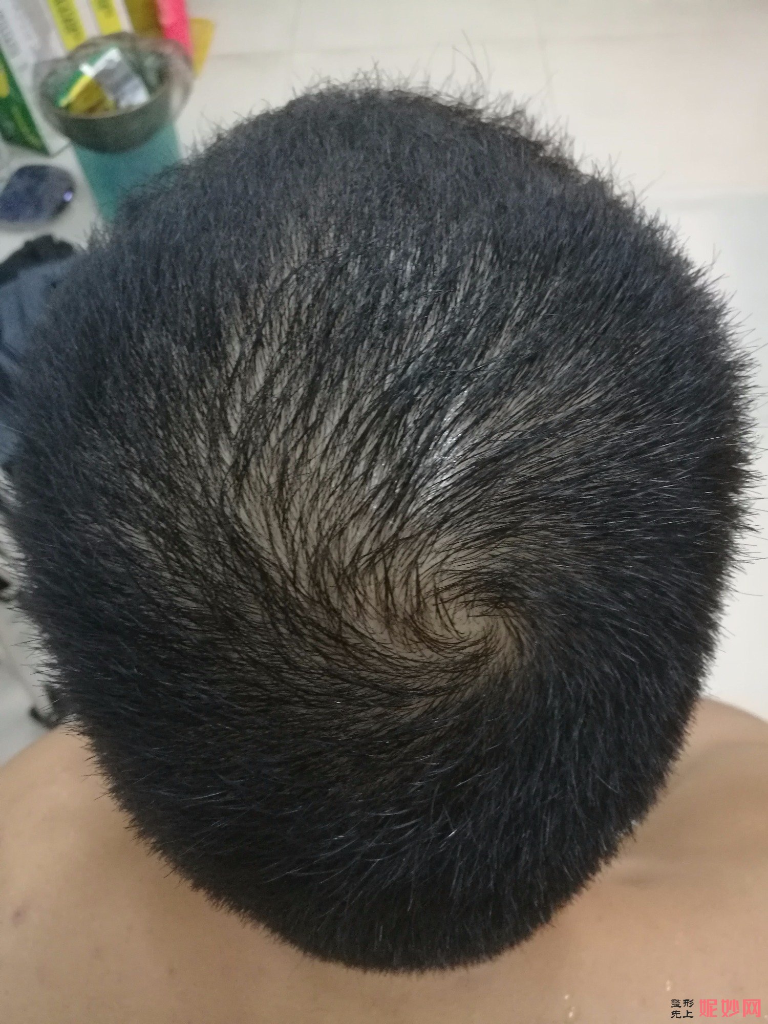 郑州和沐医疗整形口碑怎么样，附发际线种植案例_价格表