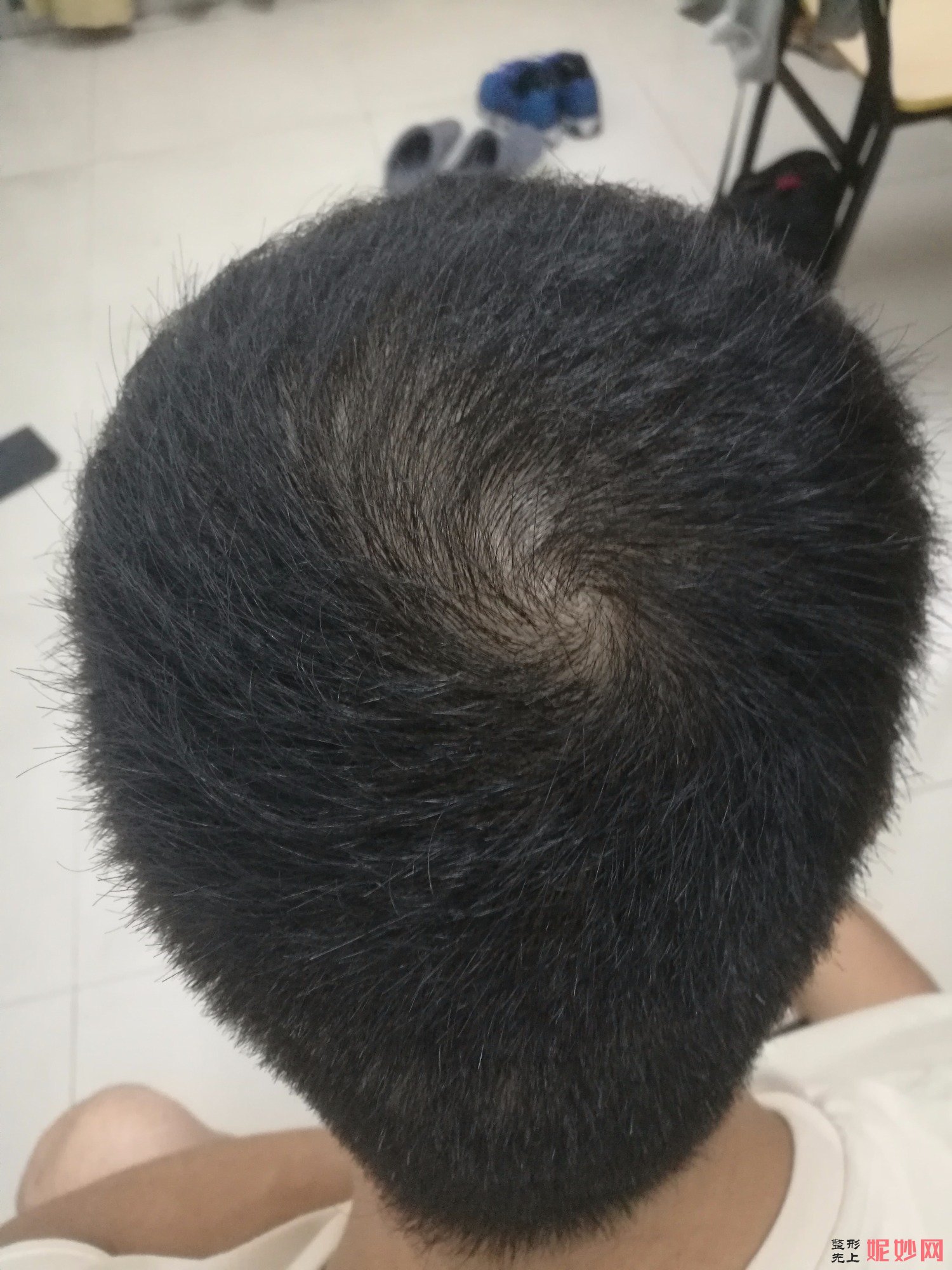 郑州和沐医疗整形口碑怎么样，附发际线种植案例_价格表