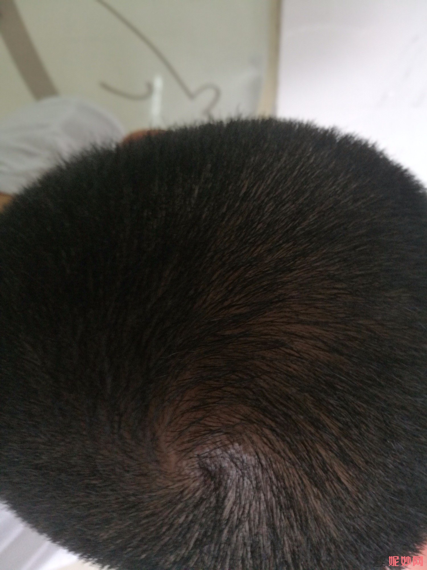 郑州和沐医疗整形口碑怎么样，附发际线种植案例_价格表