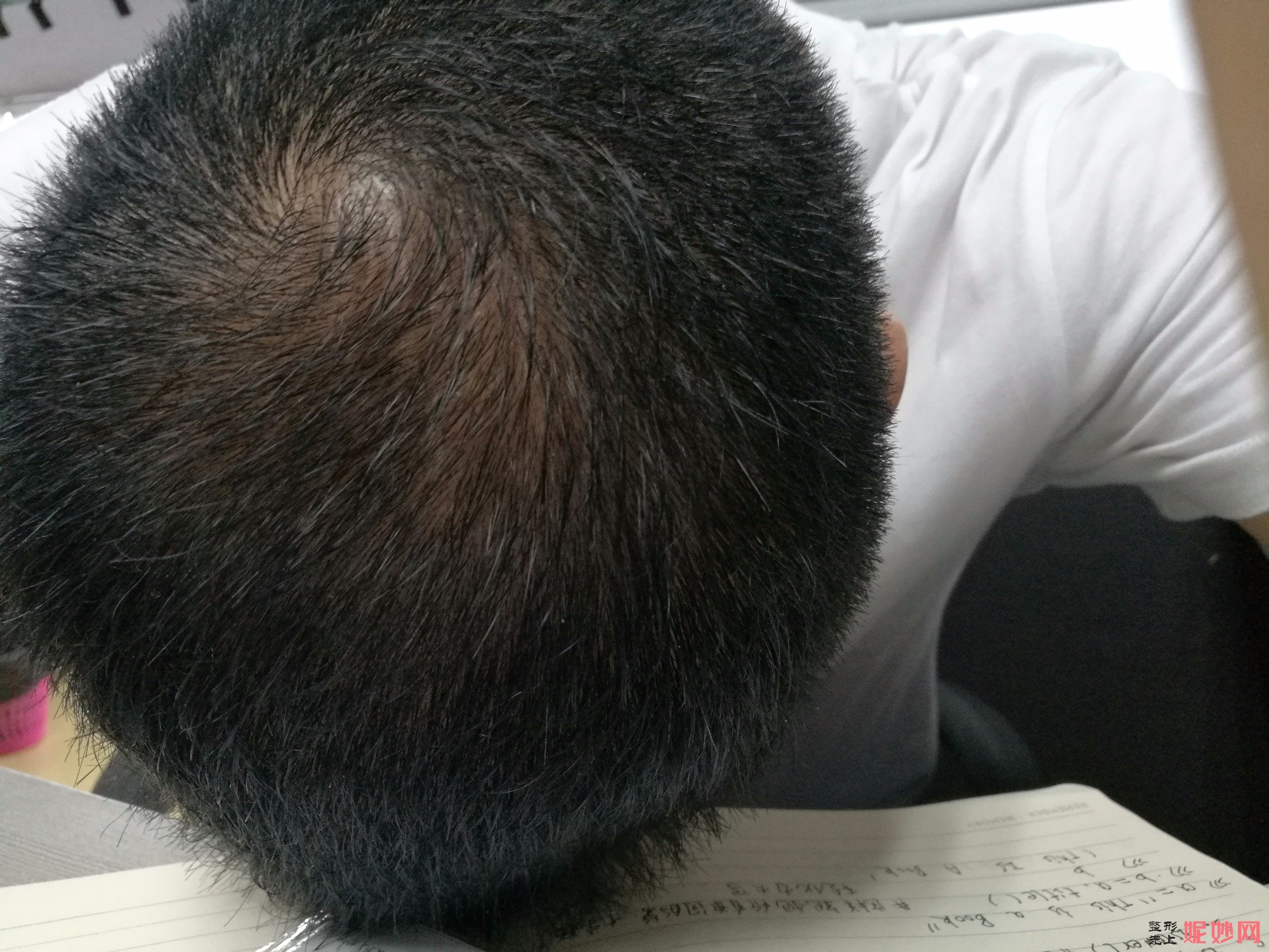 郑州和沐医疗整形口碑怎么样，附发际线种植案例_价格表