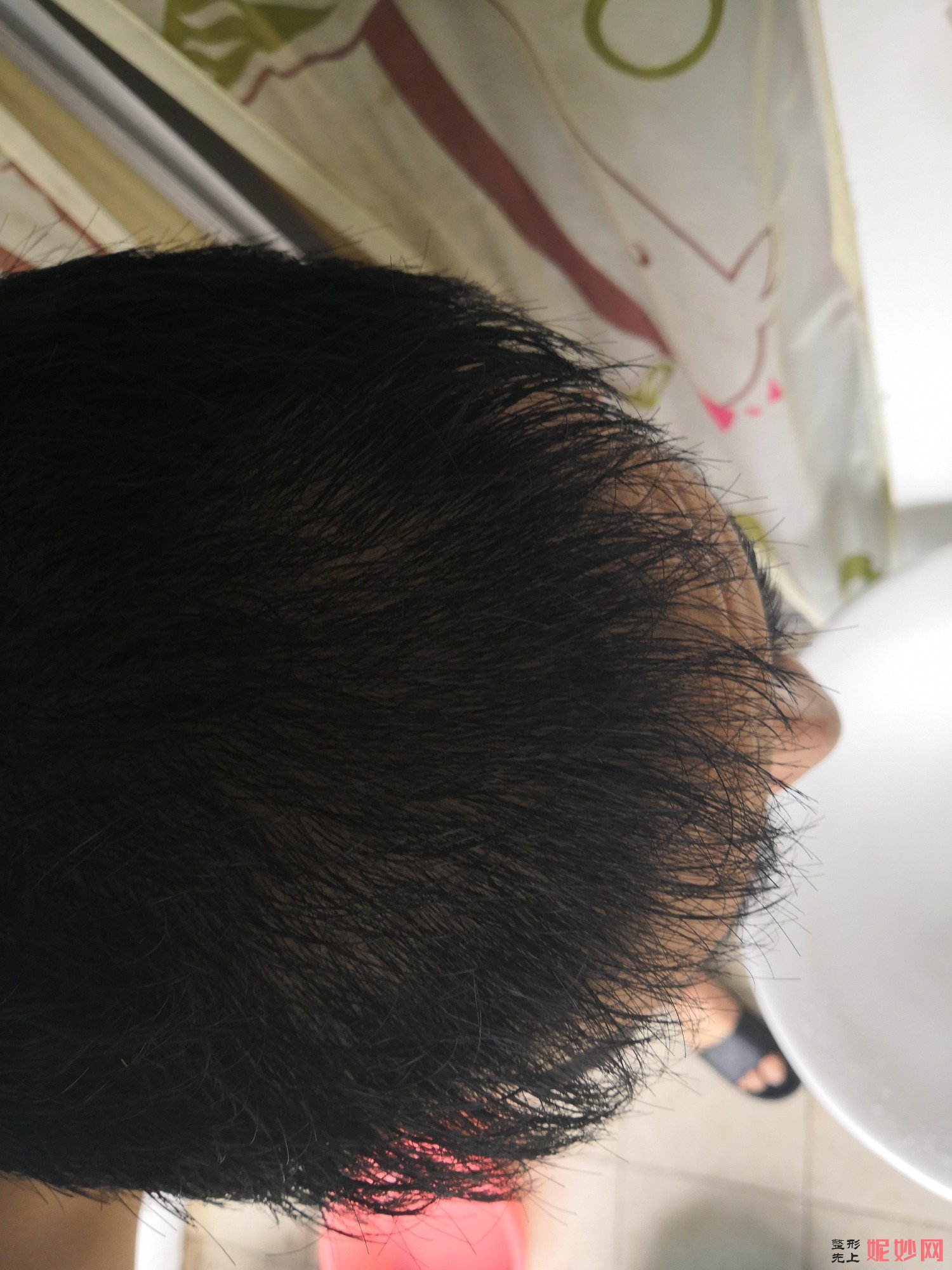 郑州和沐医疗整形口碑怎么样，附发际线种植案例_价格表
