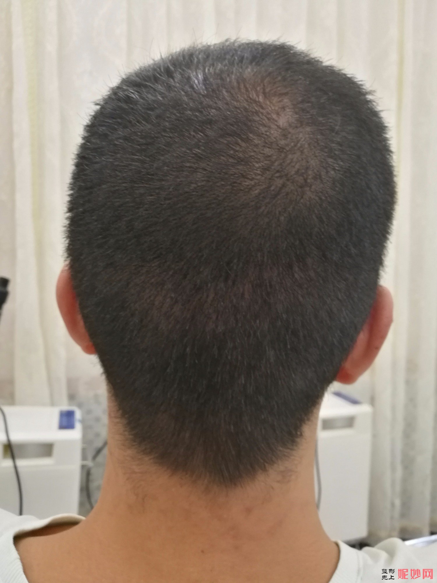 郑州和沐医疗整形口碑怎么样，附发际线种植案例_价格表