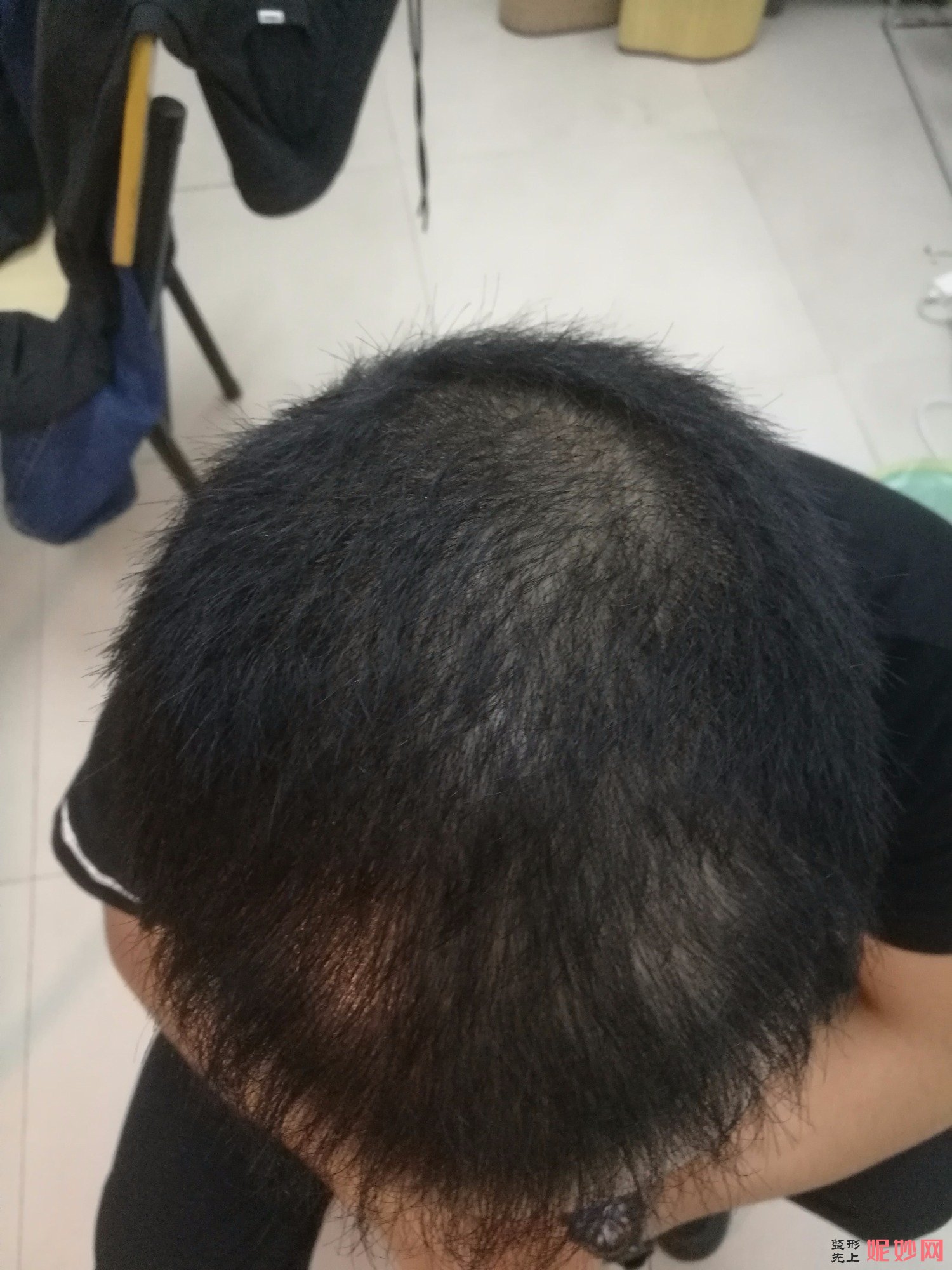 郑州和沐医疗整形口碑怎么样，附发际线种植案例_价格表