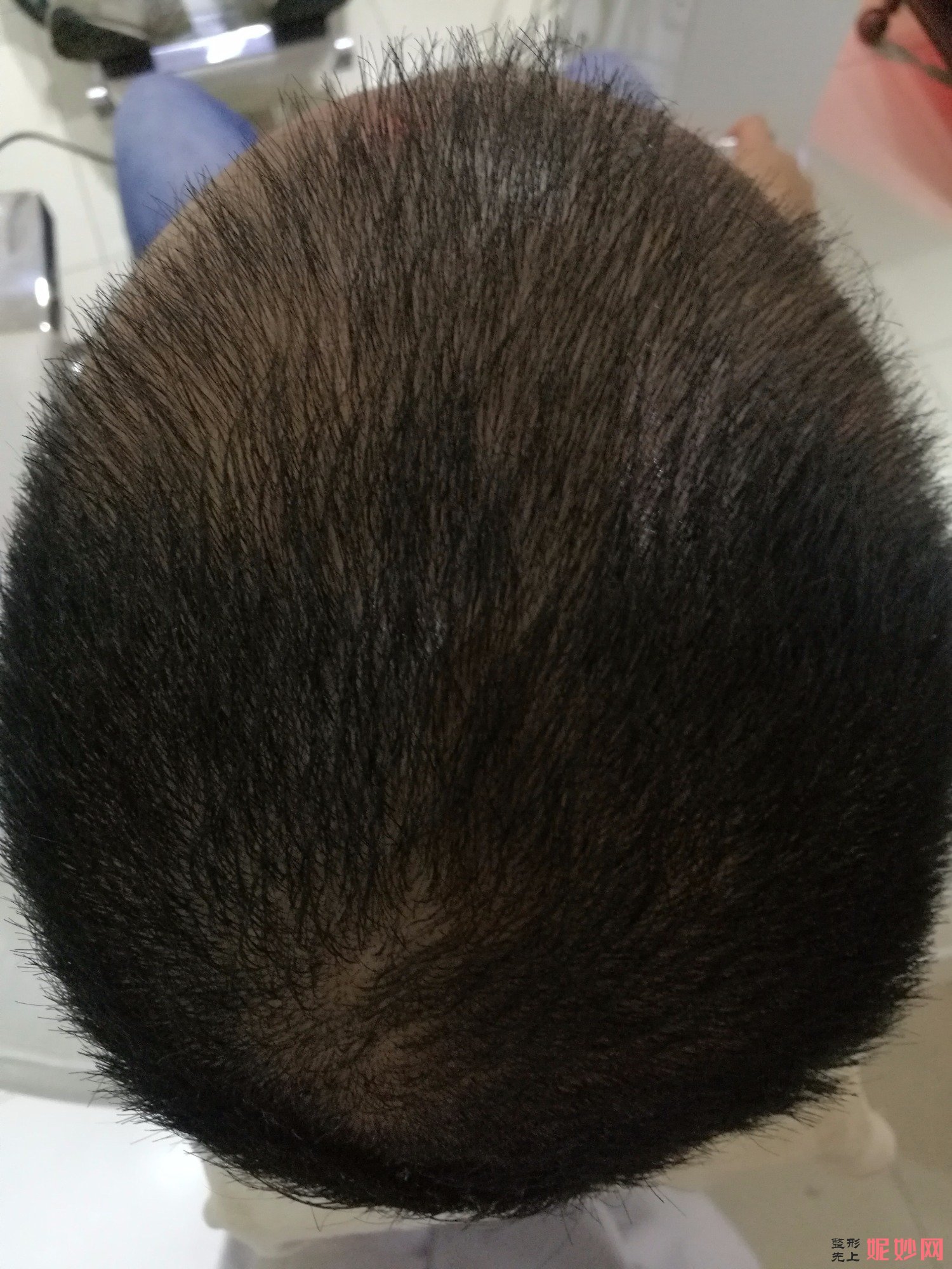 郑州和沐医疗整形口碑怎么样，附发际线种植案例_价格表