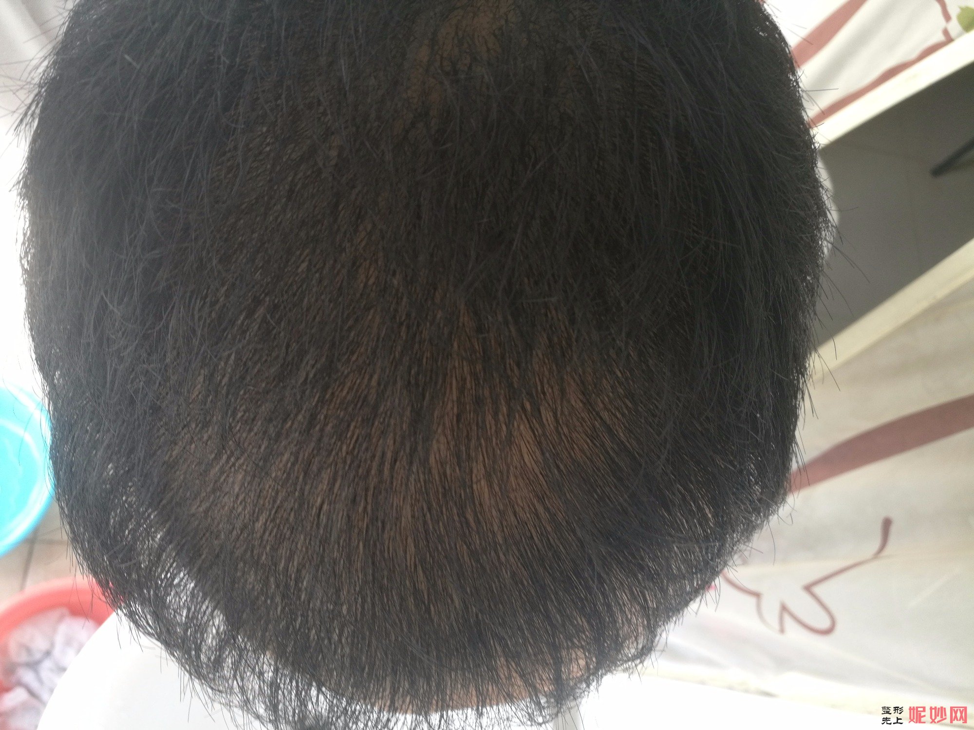 郑州和沐医疗整形口碑怎么样，附发际线种植案例_价格表