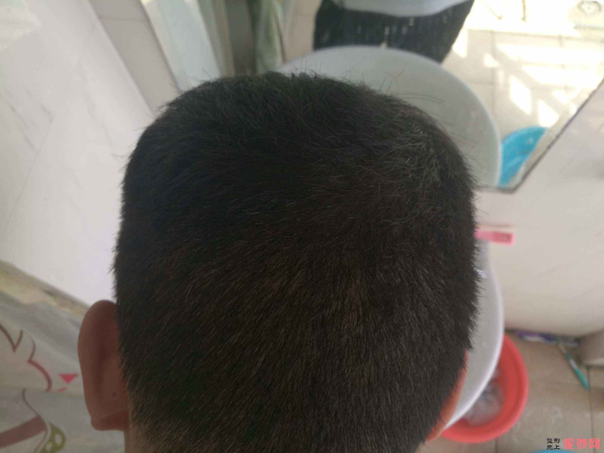 郑州和沐医疗整形口碑怎么样，附发际线种植案例_价格表