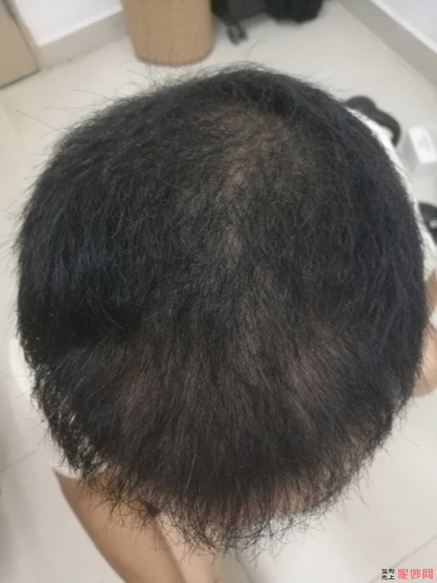 郑州和沐医疗整形口碑怎么样，附发际线种植案例_价格表