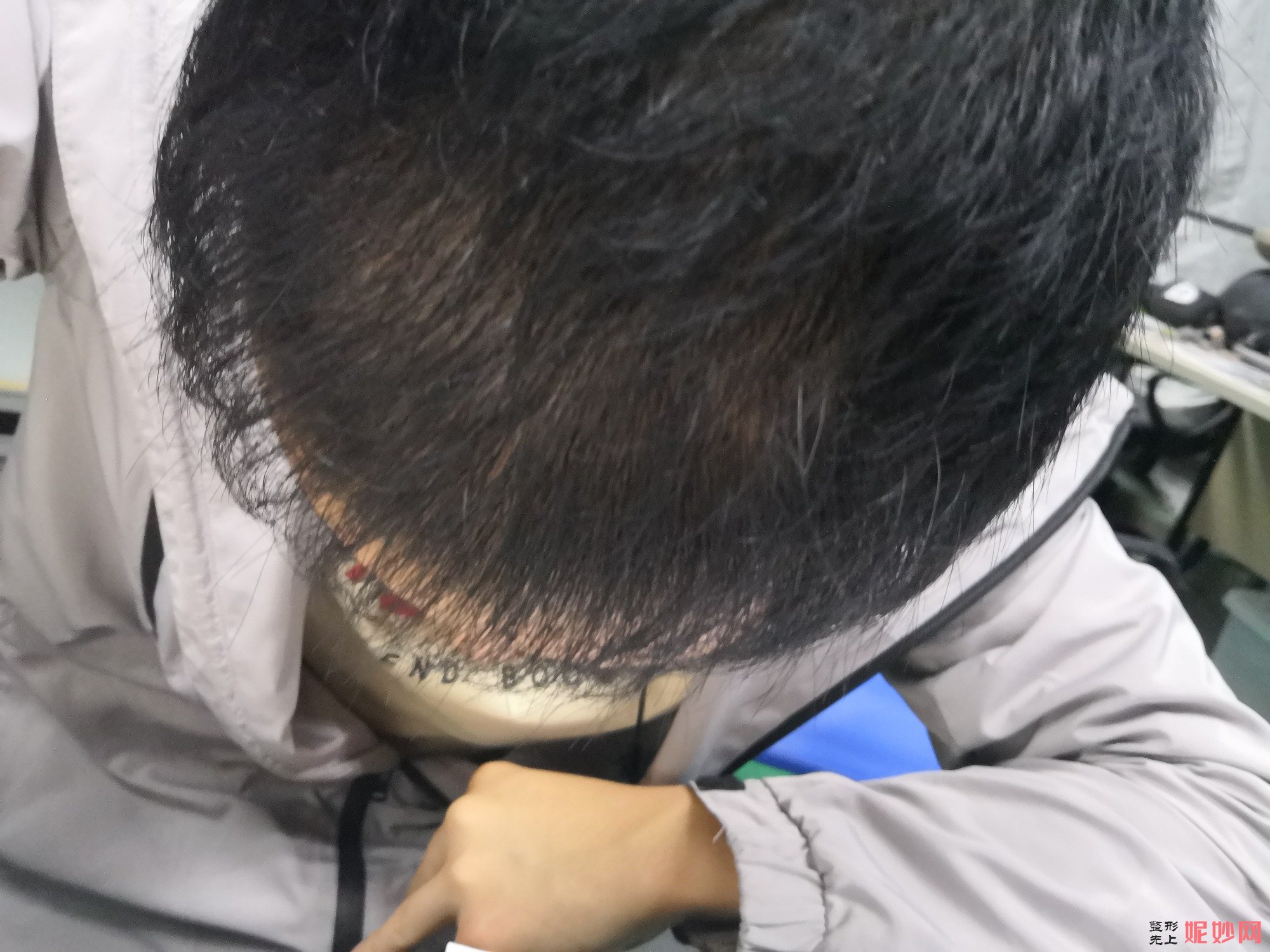 郑州和沐医疗整形口碑怎么样，附发际线种植案例_价格表