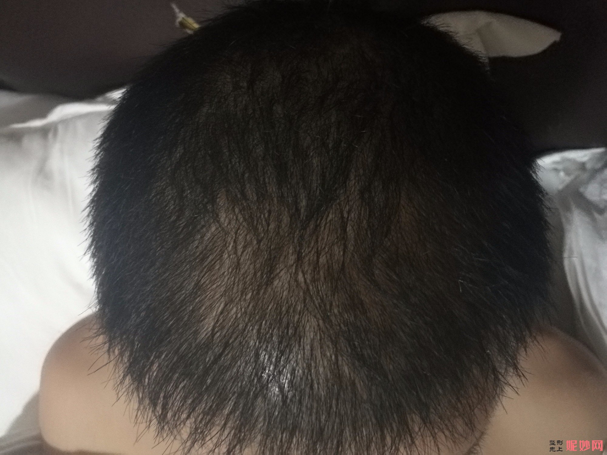 郑州和沐医疗整形口碑怎么样，附发际线种植案例_价格表