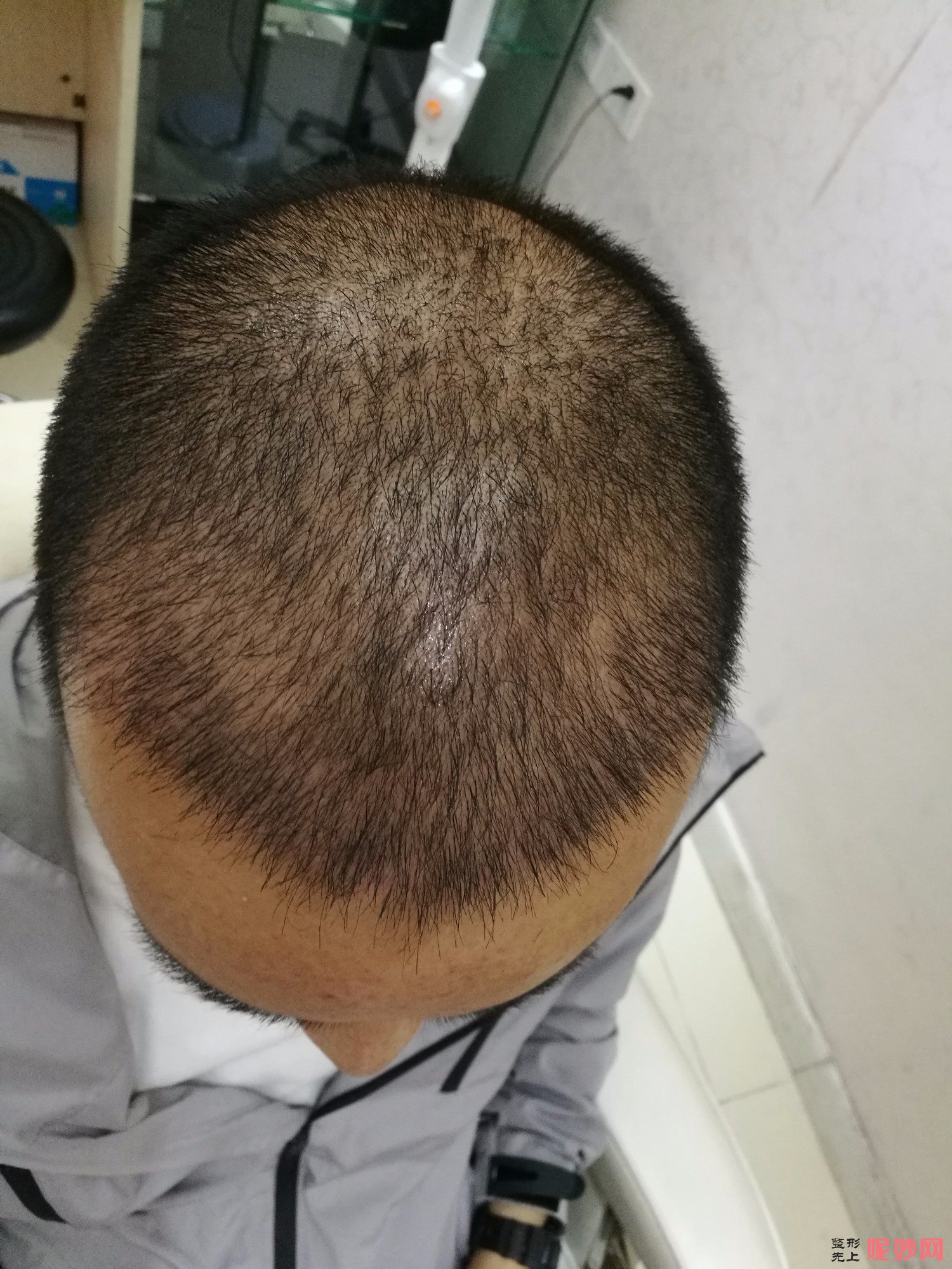 郑州和沐医疗整形口碑怎么样，附发际线种植案例_价格表