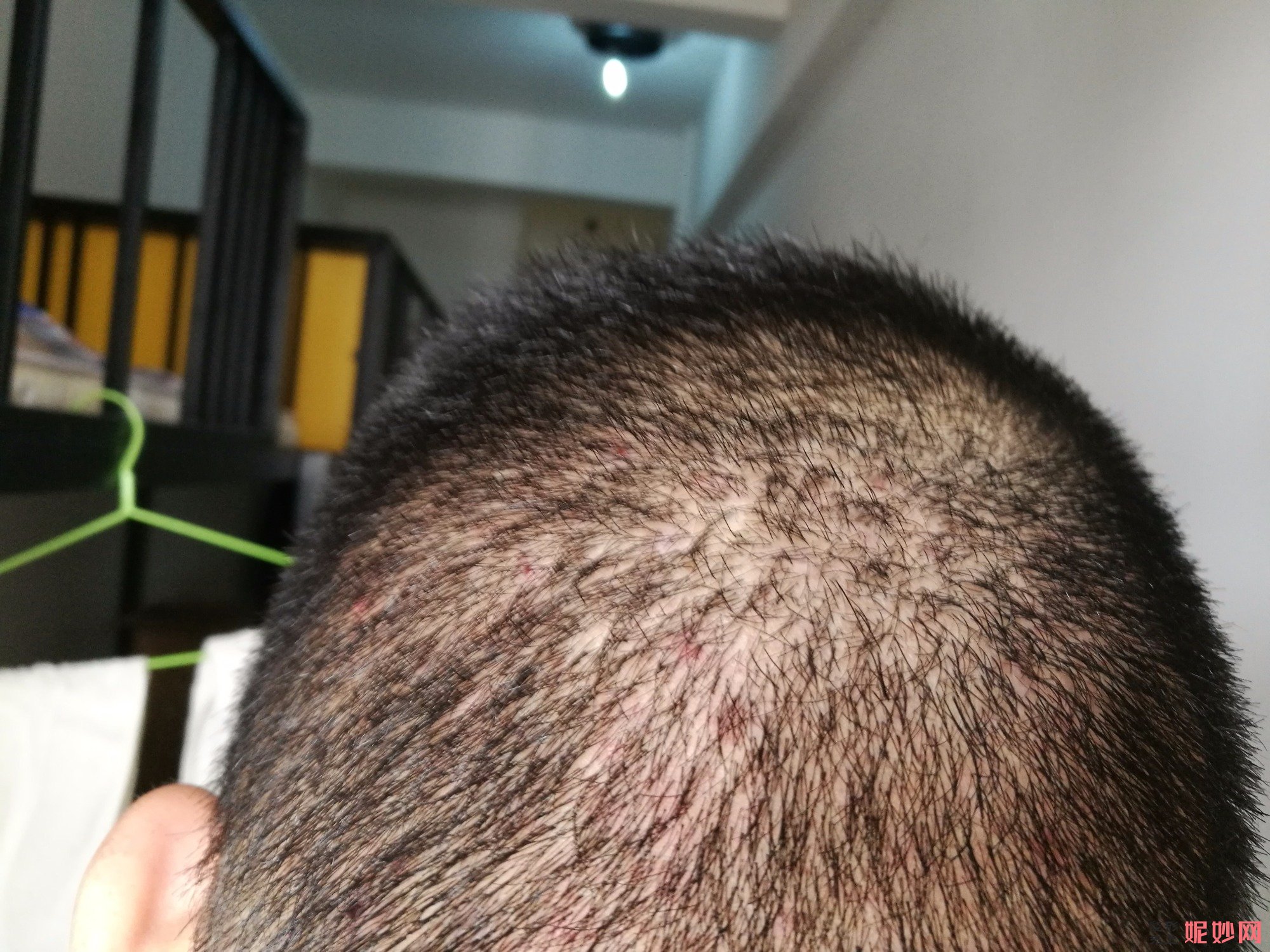 郑州和沐医疗整形口碑怎么样，附发际线种植案例_价格表