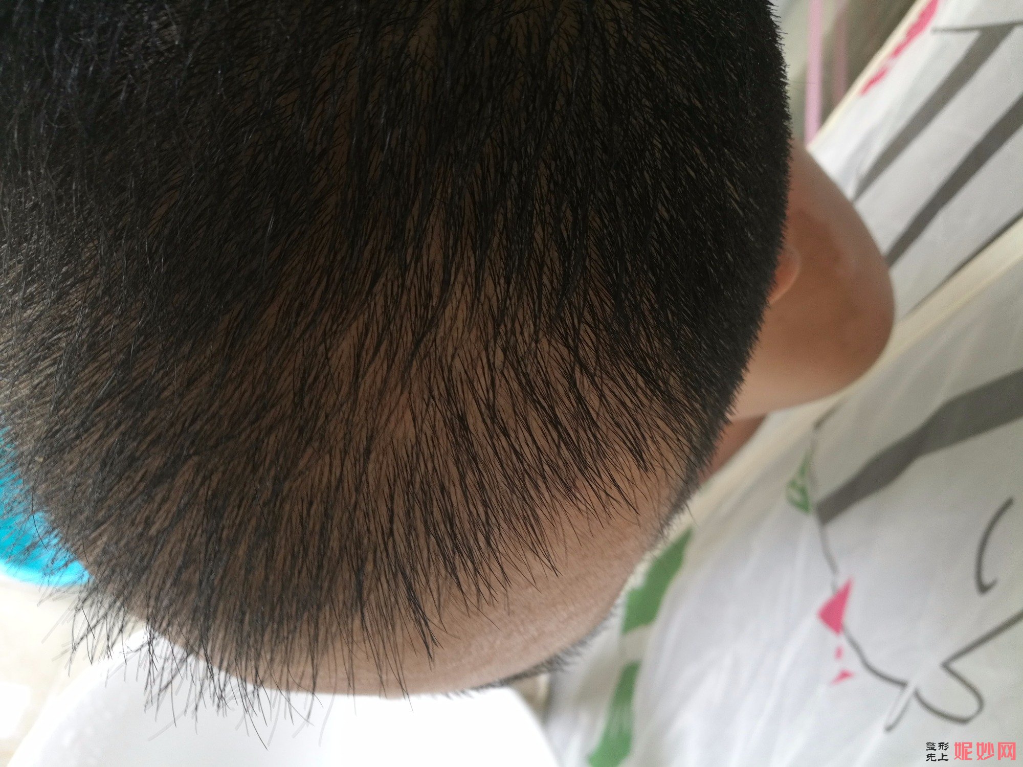 郑州和沐医疗整形口碑怎么样，附发际线种植案例_价格表