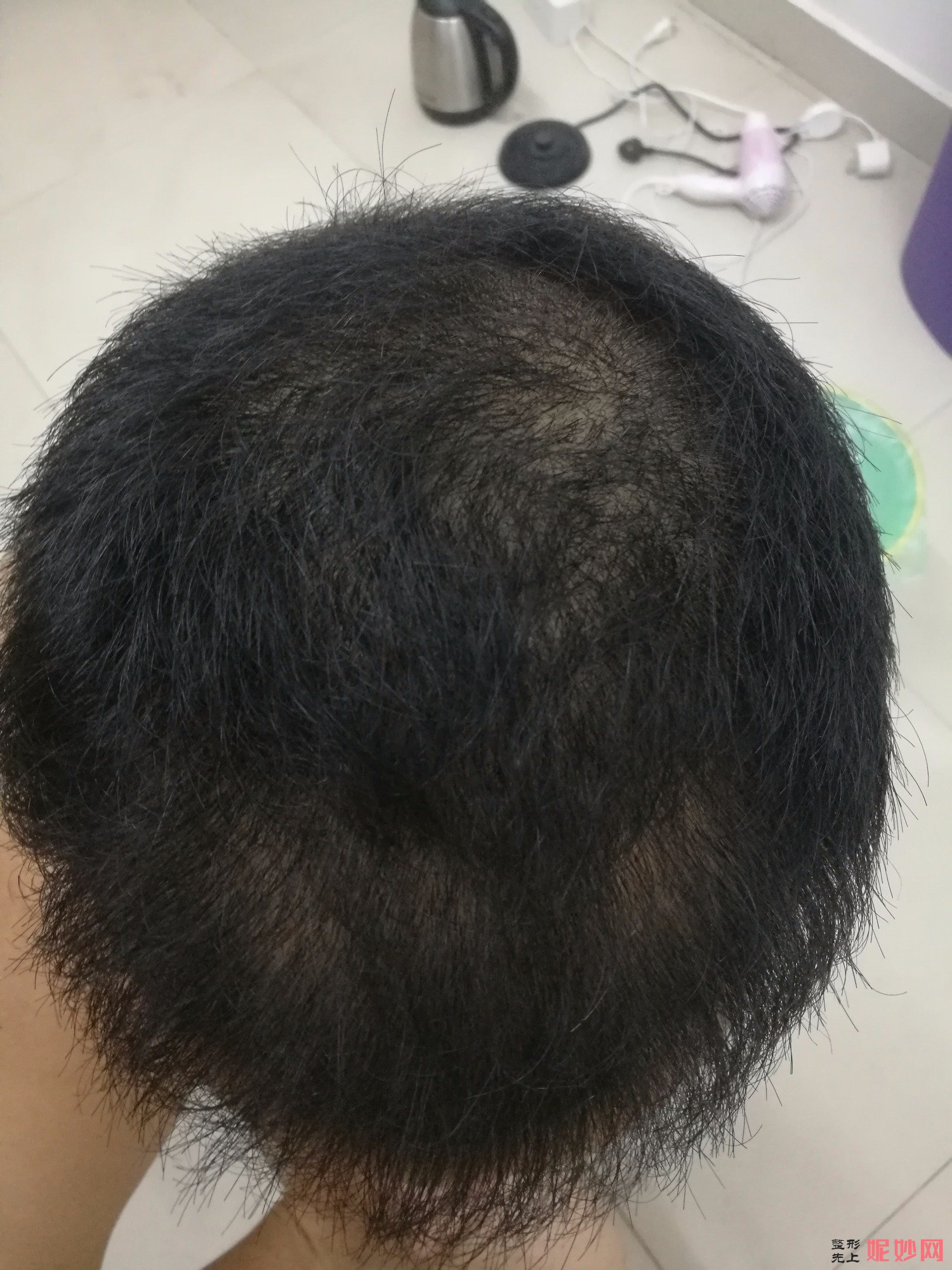郑州和沐医疗整形口碑怎么样，附发际线种植案例_价格表