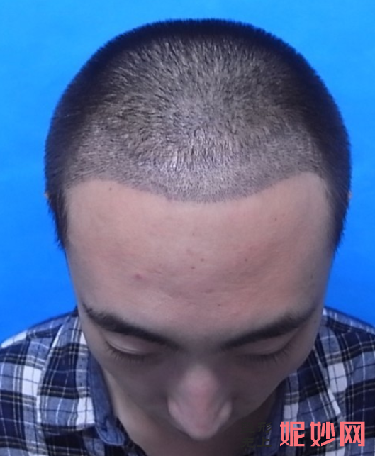 郑州天后整形美容医院靠谱吗，附发际线种植案例_价格表