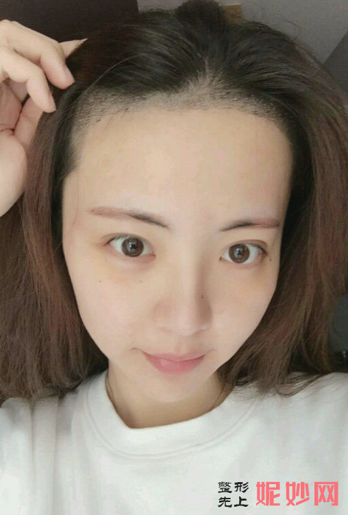 郑州华山整形医院口碑怎么样，附发际线种植案例_费用