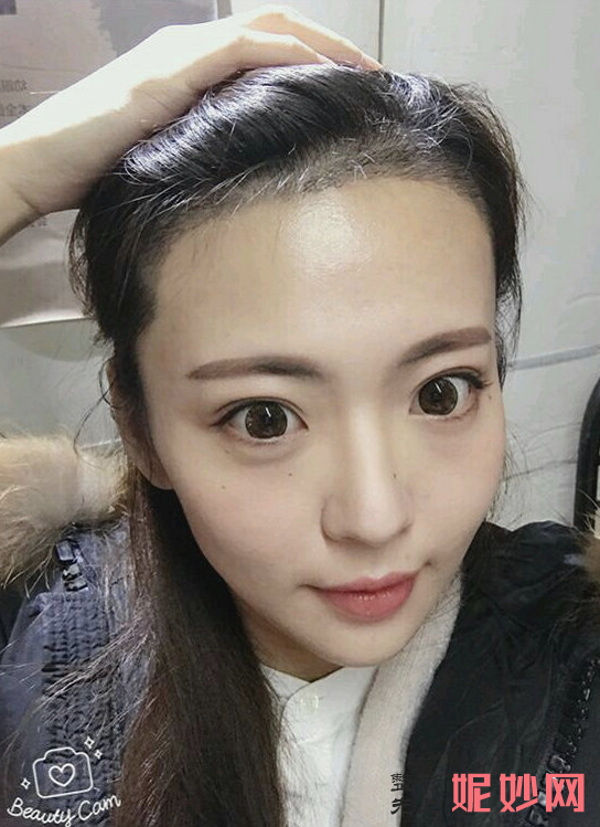 郑州华山整形医院口碑怎么样，附发际线种植案例_费用