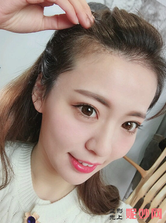 郑州华山整形医院口碑怎么样，附发际线种植案例_费用