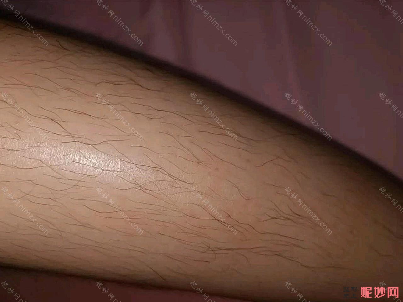 北京八大处脱毛专家介绍！有黄绿萍、陈迎涛、张玲等医生,还有案例和价格哦