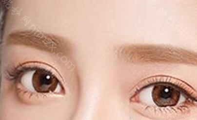 眼部整形整容医生哪个好呢？张医生做双眼皮修复的整个案例过程