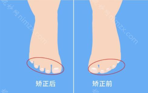 武汉哪家医院看儿童足矫正呢？武汉中翰整形医院、武汉华美整形医院哪个更好些呢？
