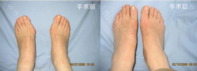 武汉哪家医院可以治疗大脚骨呢？优势大的医院介绍，看看你选择哪个？