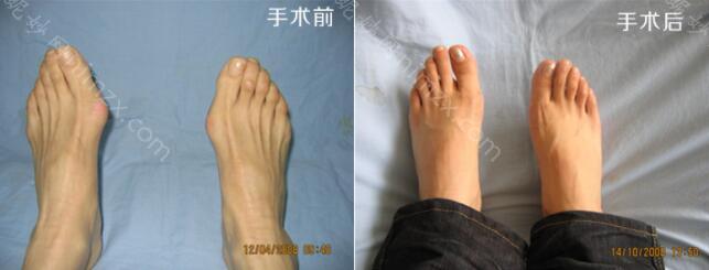 武汉哪家医院可以治疗大脚骨呢？优势大的医院介绍，看看你选择哪个？