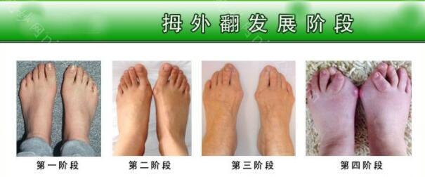 武汉哪家医院可以治疗大脚骨呢？优势大的医院介绍，看看你选择哪个？