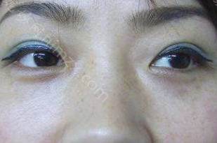 武汉吴小蔚医生做双眼皮修复技术怎么样?双眼皮修复技术案例分享